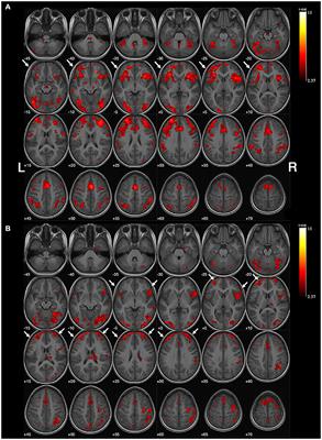 Changing handedness after nerve reconstruction in brachial plexus birth palsy